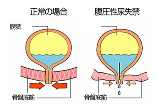 尿失禁 切迫性尿失禁など を呈する患者への看護目標 看護計画とケア ナースのヒント