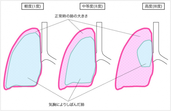 気胸の看護|重症度に合わせた対処法と術後・入院生活のフォロー | ナースのヒント