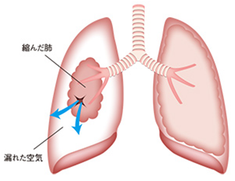 気胸 G-04胸膜疾患
