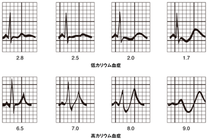 低カリウム血症および高カリウム血症の心電図パターン