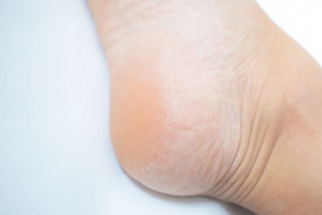 落屑の看護 高齢者など落屑の多い患者に対する看護問題と皮膚ケア ナースのヒント