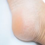 落屑の看護｜高齢者など落屑の多い患者に対する看護問題と皮膚ケア