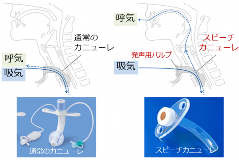 気管切開後のカニューレ除去後のケアは何ですか?