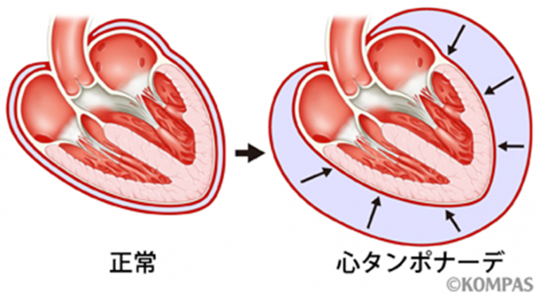 心労