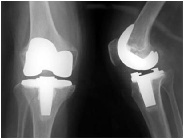 人工膝関節置換手術