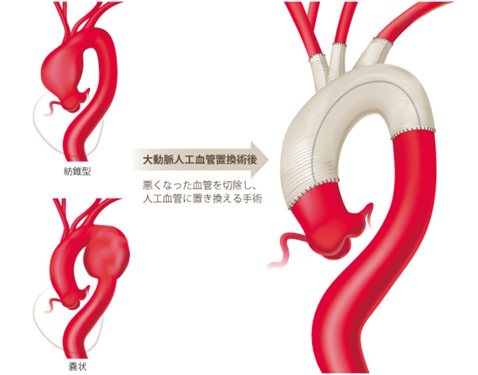 大動脈解離の手術