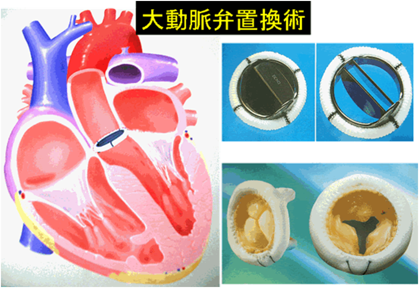 大動脈弁狭窄症の看護｜観察項目、看護計画、手術後の ...