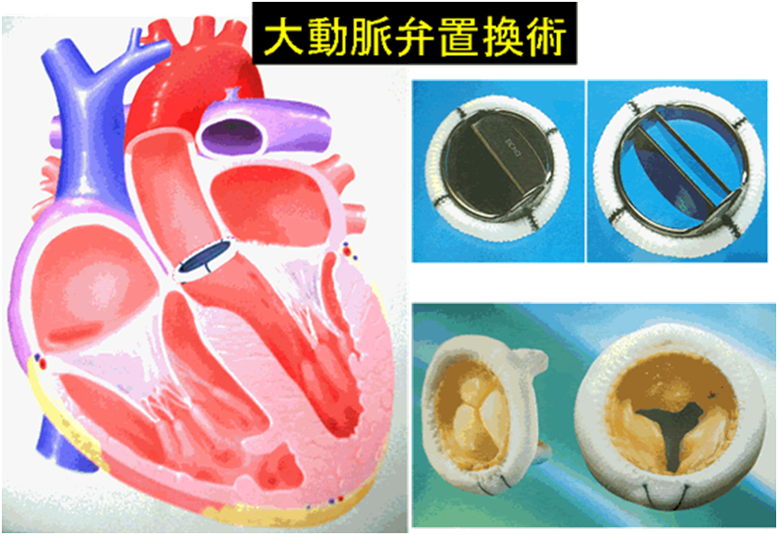 大動脈弁の手術