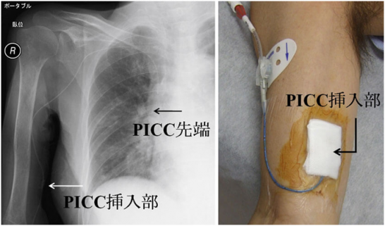 PICCカテーテルの看護｜安全な管理方法と観察ポイント ナースのヒント