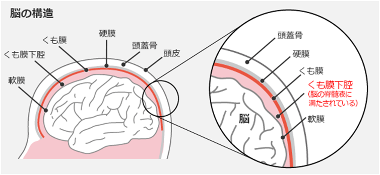 くも膜下腔内化学療法後の見通しはどうなりますか?