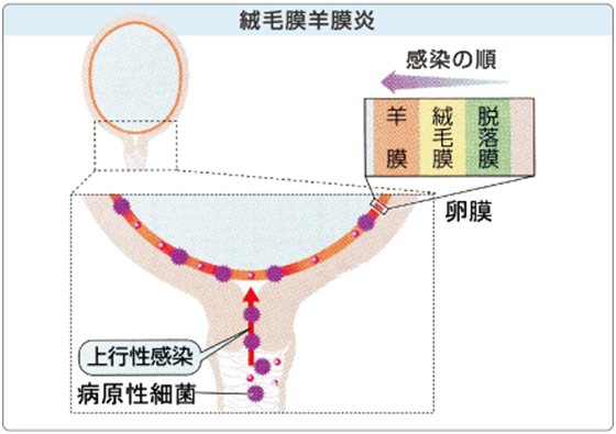 前期破水の看護計画 原因と感染リスク 看護問題 看護目標とケア ナースのヒント