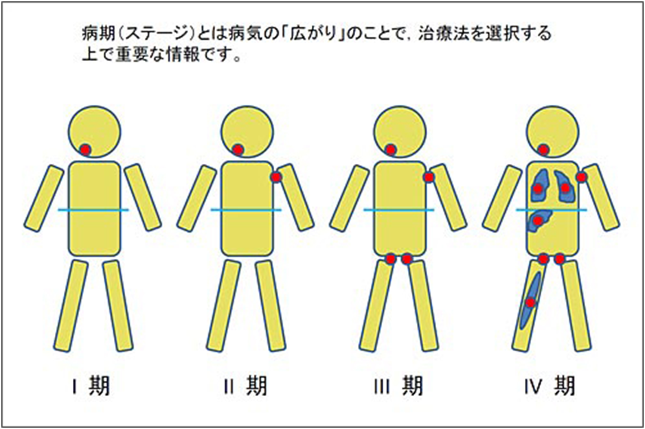 悪性リンパ腫の治療