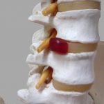 腰部脊柱管狭窄症の看護｜腰部脊柱管狭窄症に対する治療法と看護計画