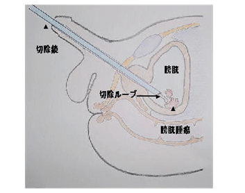 経尿道的膀胱腫瘍切除術（TUR-Bt）とは
