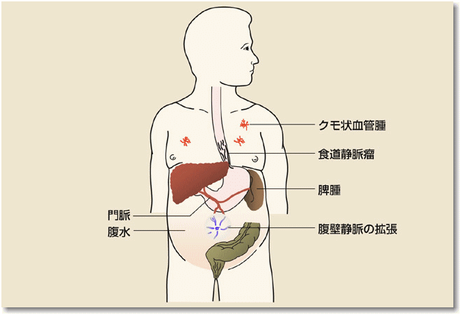 腹部膨満感の看護 腹部膨満感を呈する３つの原因および症状緩和のためのヒント ナースのヒント