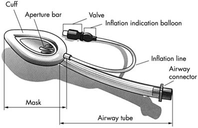 The laryngeal mask airway: potential applications in neonates