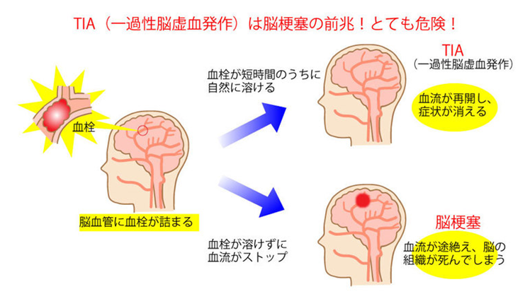 一過性脳虚血発作 Tia の看護 原因 症状からみる３つの看護ポイント ナースのヒント