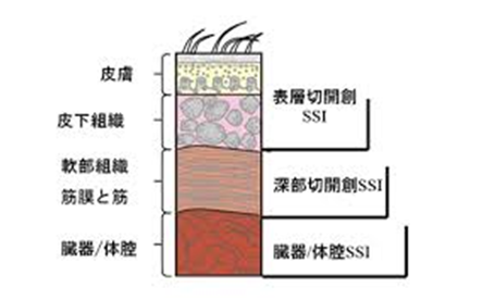 SSIの感染部位