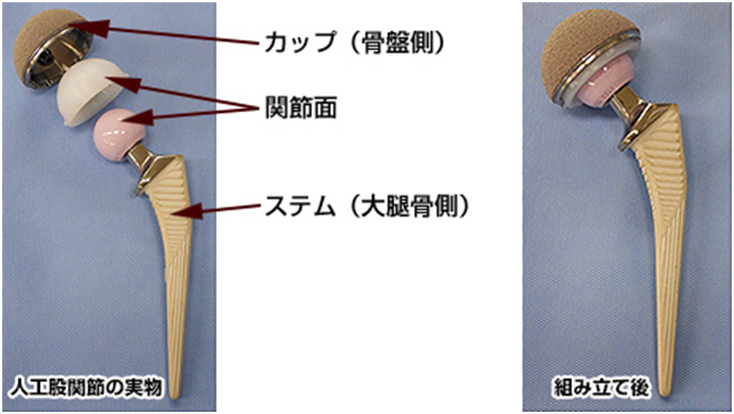 人工股関節置換術 Tha の看護 合併症や5つの術後看護計画 ナースのヒント