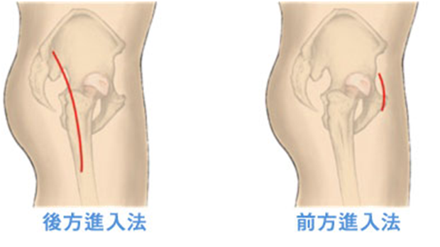 人工股関節置換術 Tha の看護 合併症や5つの術後看護計画 ナースのヒント