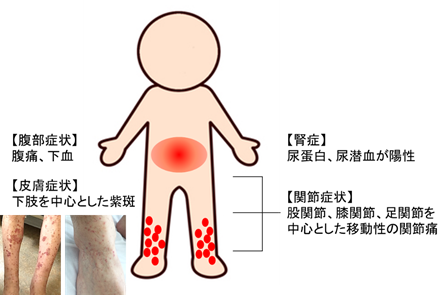 2025年最新】IgA血管炎の看護｜原因や症状、ガイドラインや看護 